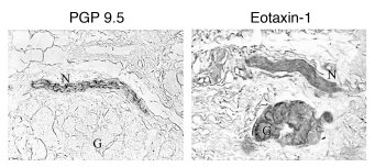 Immunostaining of human airway nerves for eotaxin.
Airway nerves were la...