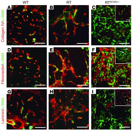 Severe α-SMA+ cellular phenotypes are associated with changes in the exp...