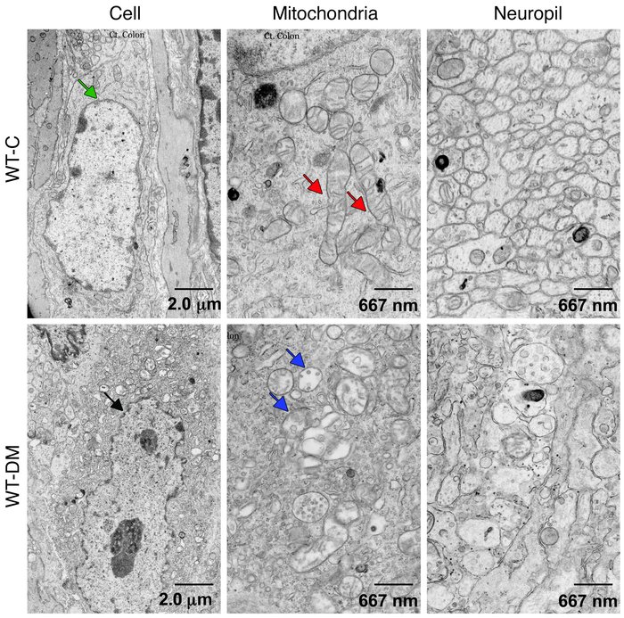 Diabetes is associated with electron microscopic evidence of myenteric n...