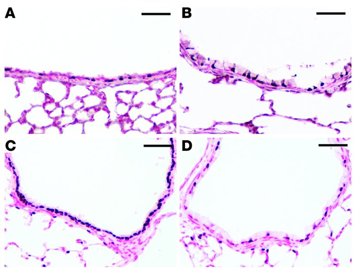 FOXJ1 and loss of FOXA2 staining in lungs of CCSP-rtTA/TRE2-Spdef transg...