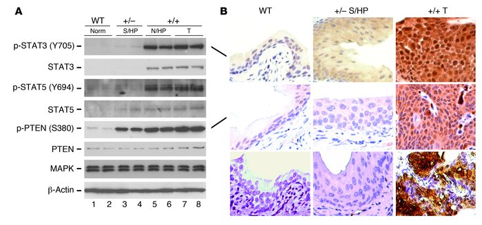 Activation of STAT3 and STAT5 and inactivation of PTEN during urothelial...
