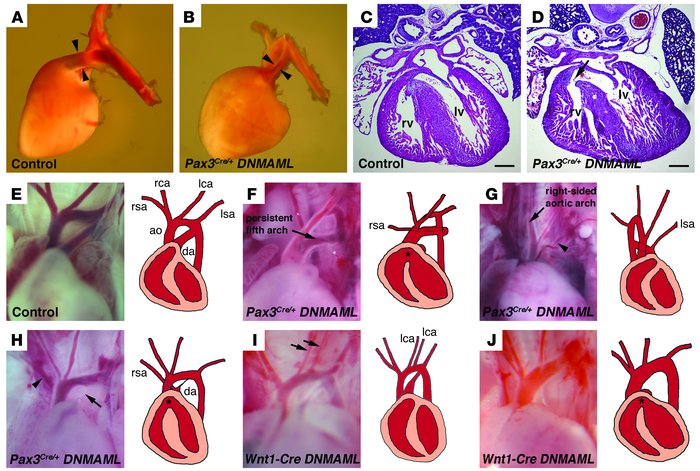 Neural crest–specific expression of DNMAML results in cardiac outflow tr...