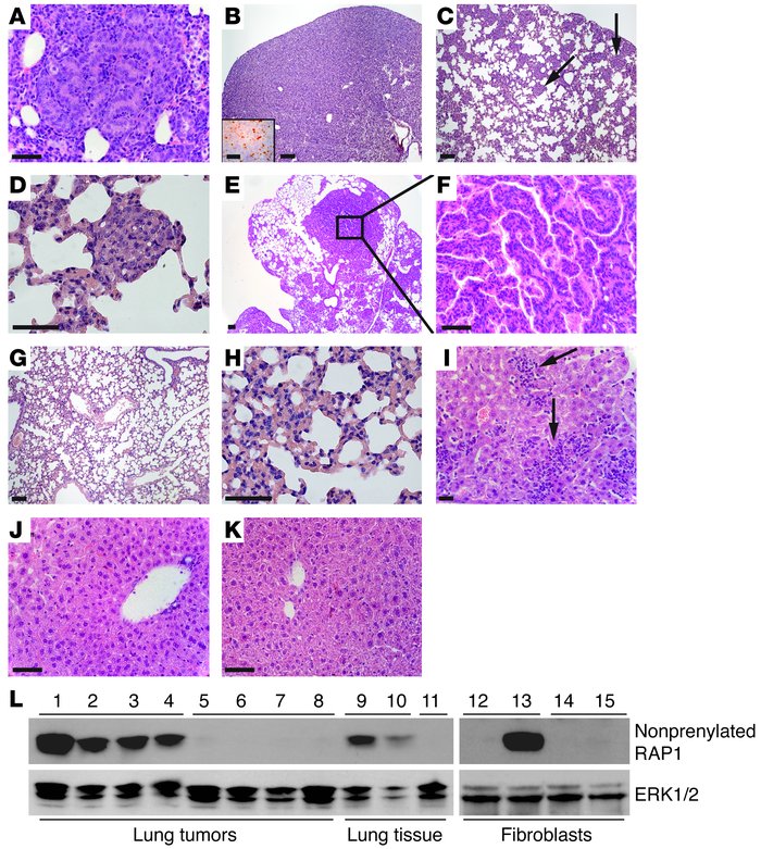 
Pggt1bfl/+KLSLLC mice develop lung cancer and hepatic leukocyte infiltr...