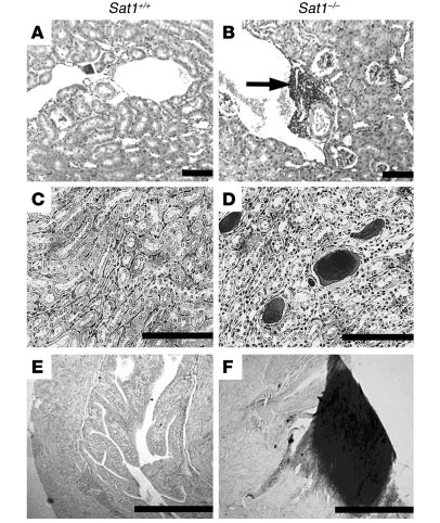 Urolithiasis in Sat1–/– mice.
   
(A and B) Representative H&amp;E-stain...