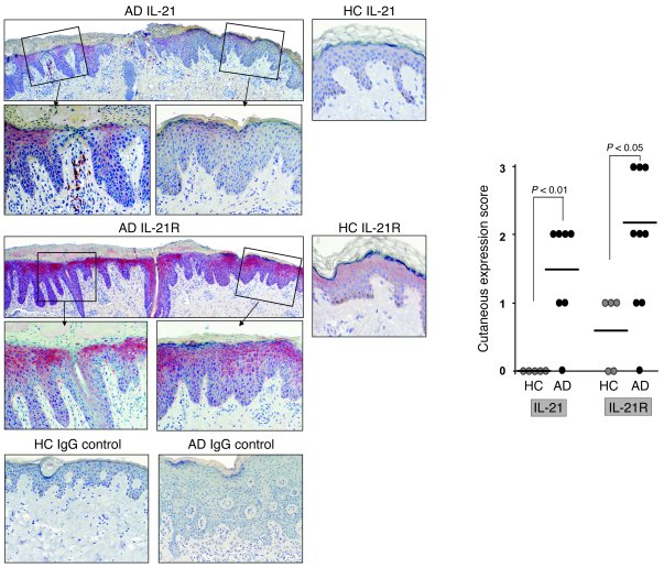 IL-21 and IL-21R expression is upregulated in skin lesions of acute AD p...