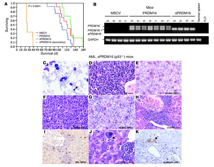 AML induced by sPRDM16 in the p53–/– background.
               
(A) Ove...