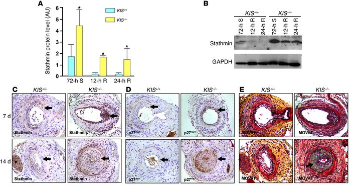 Increased stathmin expression in KIS–/– VSMCs.
   
(A) Quantitative anal...