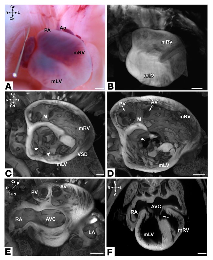 Superior-inferior ventricles and AV canal defect.
(A) Superior-inferior ...