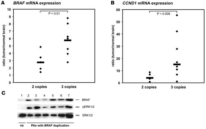 
BRAF and CCND1 expression in primary pilocytic astrocytomas.
   
(A) BR...