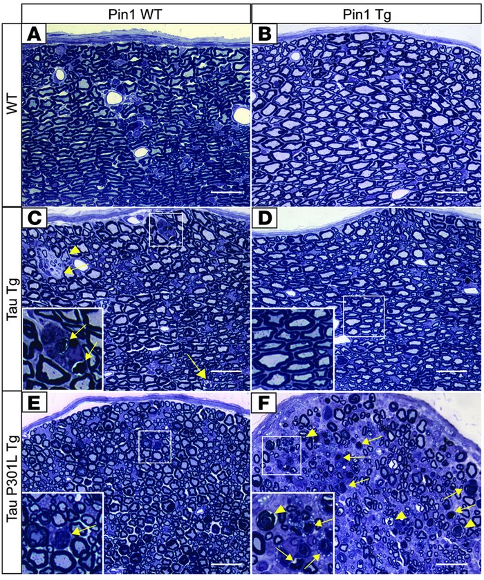 Opposite effects of Pin1 overexpression on peripheral neuropathies of WT...