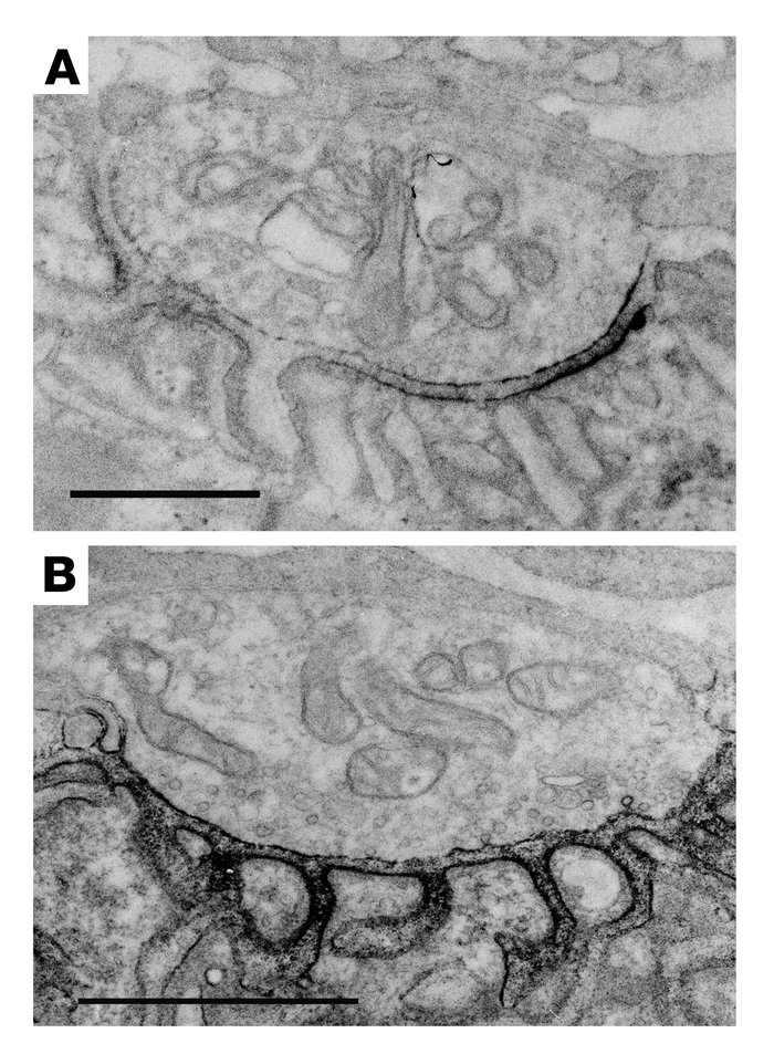 EM localization of AChR with peroxidase-labeled α-bgt at patient (A) and...