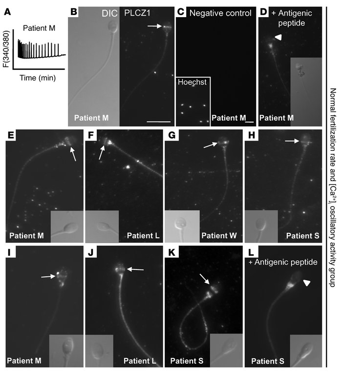 PLCZ1 localizes to the equatorial/postacrosomal region of human sperm.
T...
