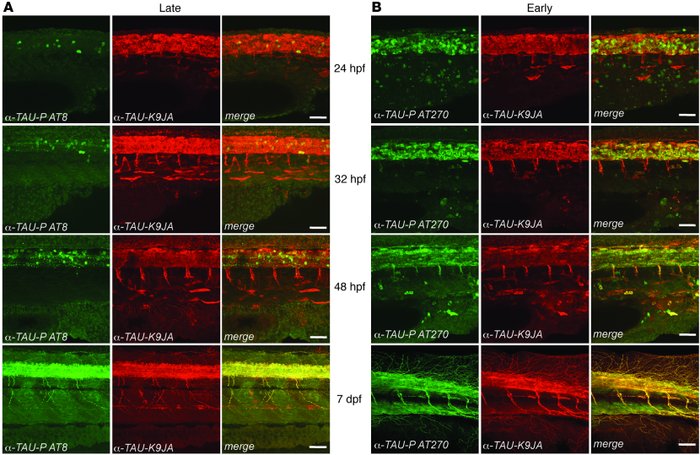 Rapid progression of AT8-positive late-stage FTD/AD-like pathology in tr...