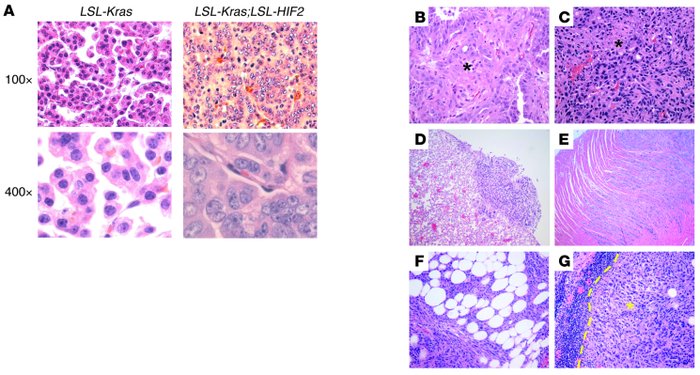 HIF2α-producing tumors are pleomorphic and invasive.
(A) Representative ...