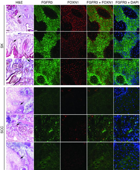 Different expression levels of FOXN1 and FGFR3 in SK versus SCC tissue s...