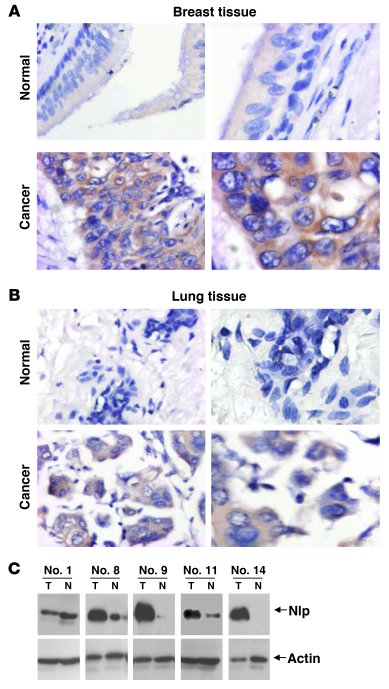 Deregulated expression Nlp in human lung and breast carcinomas.
(A) Norm...