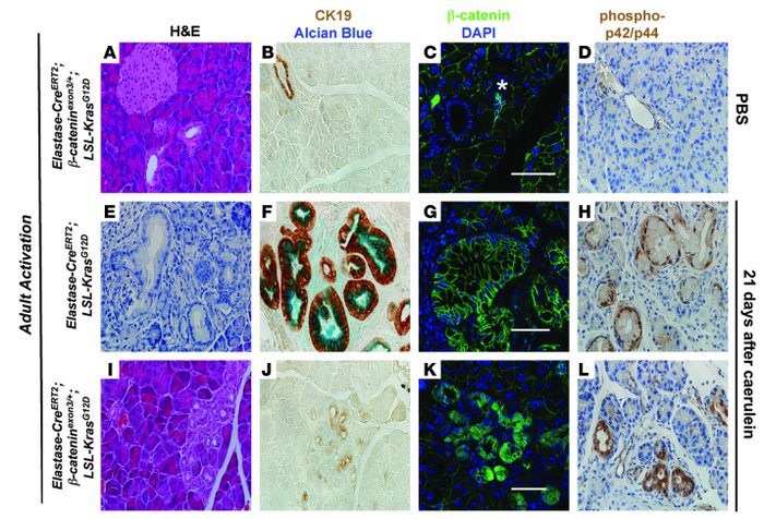 β-catenin signaling inhibits Kras-induced reprogramming of acini into Pa...