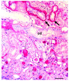 Renal histology of patient A131 II-4.
Morphologic changes are characteri...