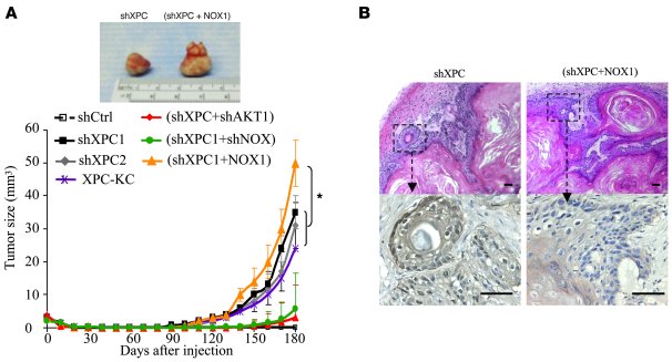 XPC silencing drives neoplastic transformation of human keratinocytes vi...