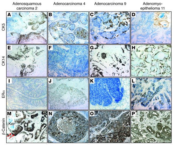 Most RbΔfl mammary tumors express variable levels of basal cytokeratins,...