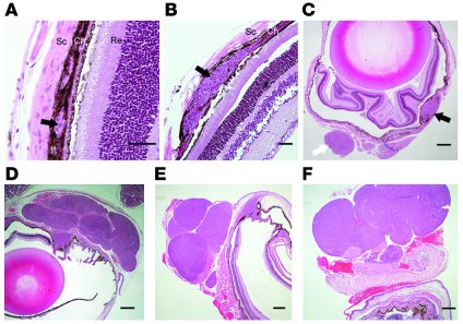 Morphology of eye tumors at various ages.
Eye sections from 2- (A), 4- (...