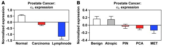 Expression of α2β1 integrin expression correlates with prostate cancer p...