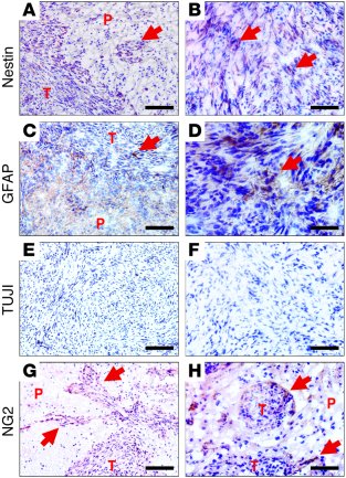 Tumors derived from Ink4a/Arf–/– PDGFRα mAsts express markers of neural ...