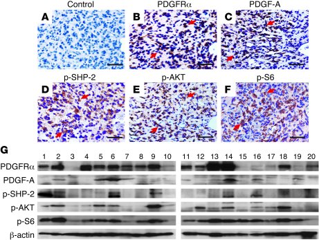 PDGFRα and PDGF-A are co-expressed in clinical glioma specimens with act...