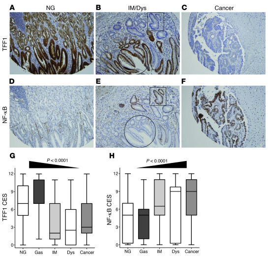Immunohistochemistry for TFF1 and NF-κB in human samples.
(A–F) Immuno­h...