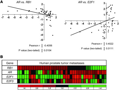 AR levels correlate inversely with RB levels and directly with E2F1 leve...