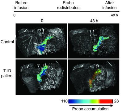 Insulitis may be visualized by MRI.
Shown are T2-pseudocolor reconstruct...