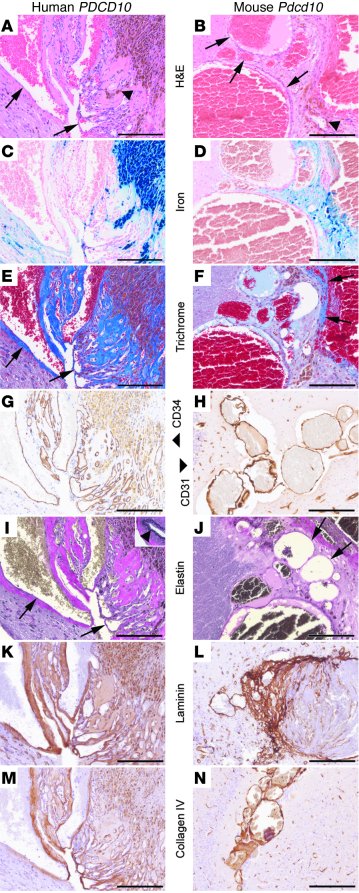 Pathologic analysis of mouse and human PDCD10-associated CCM.
   
Paired...