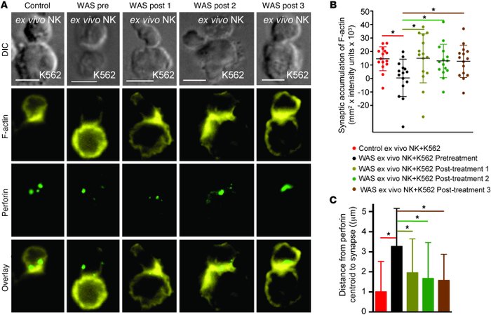 In vivo IL-2 administration of IL-2 to a WAS patient restores F-actin ac...