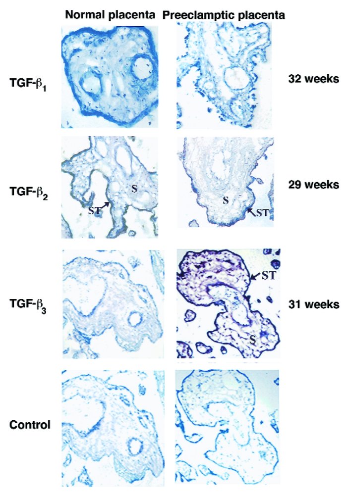 Immunoperoxidase staining of TGF-β1, TGF-β2, and TGF-β3 was performed in...