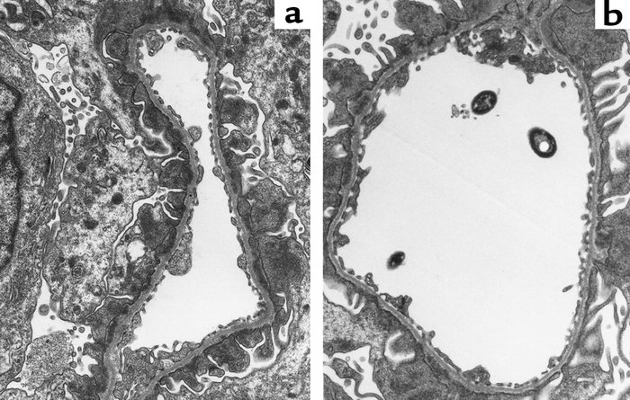 Glomerular ultrastructure in rats with PHN on day 7 after disease induct...