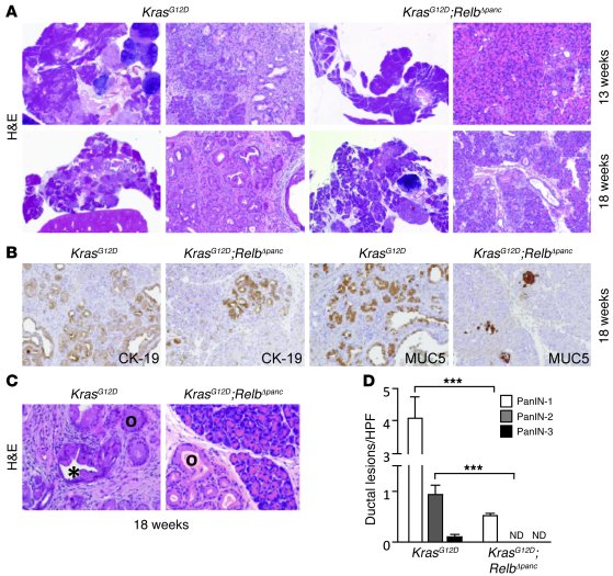 RelB is essential for PanIN progression.
(A) Representative H&amp;E-stai...