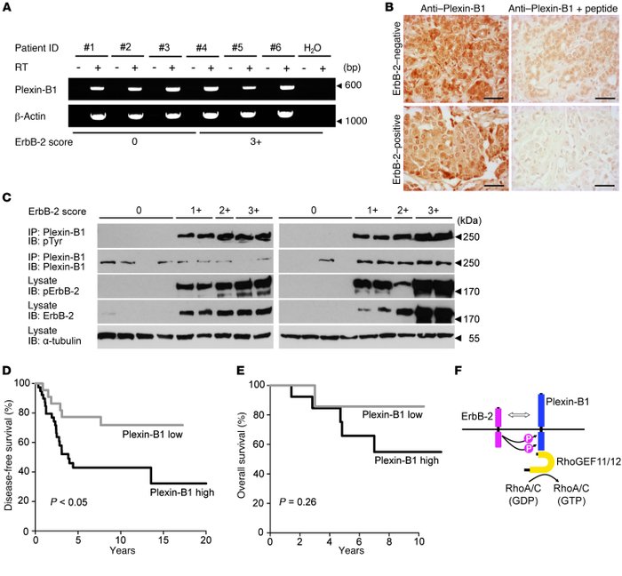 Plexin-B1 is activated in ErbB-2–positive human breast cancer, and its e...