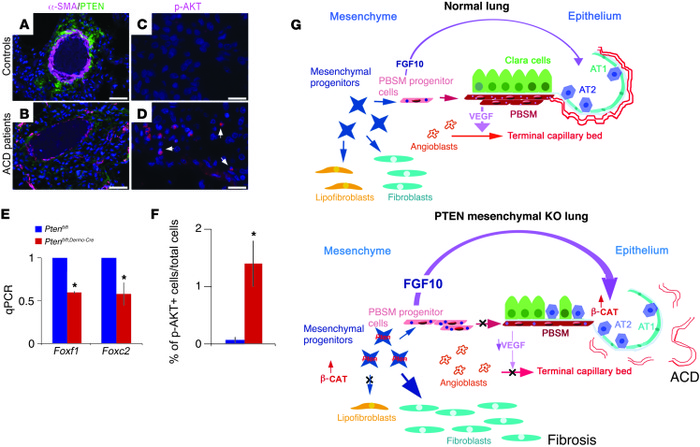 Human newborn ACD lungs display decreased PTEN and increased p-AKT.
(A a...