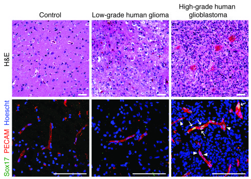 Sox17 is highly expressed in tumor vessels in human glioblastoma.
Sox17 ...