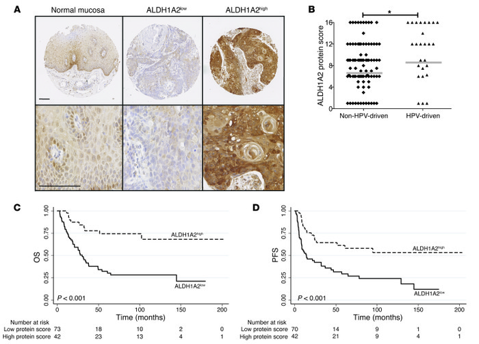 Correlation of ALDH1A2 protein expression and clinical outcome of OPSCC ...