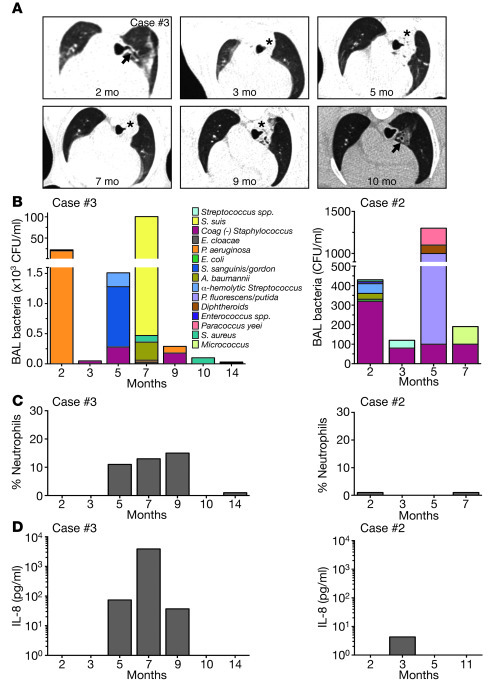 Airway disease is dynamic in CFTR–/–;TgFABP&gt;pCFTR pigs.
 
(A) Serial ...