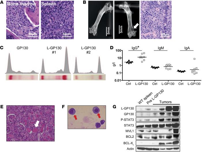 L-GP130–induced myeloma is characterized by gammopathy with kidney damag...