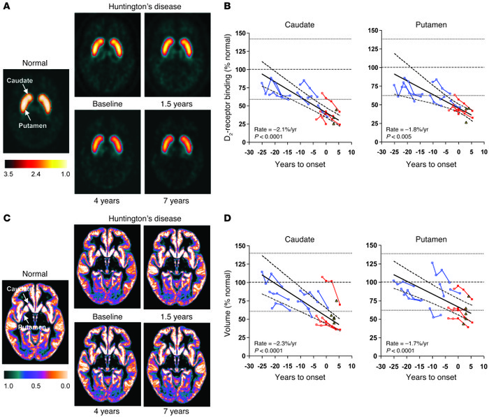 Longitudinal changes in striatal D2 receptor binding and tissue volume.
...