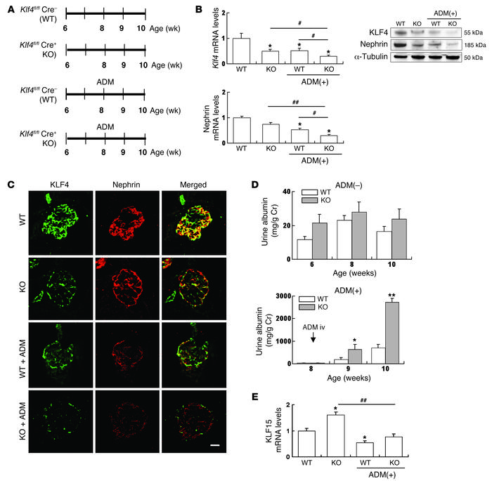Knockdown of KLF4 in podocytes exacerbates proteinuria in ADM nephropath...