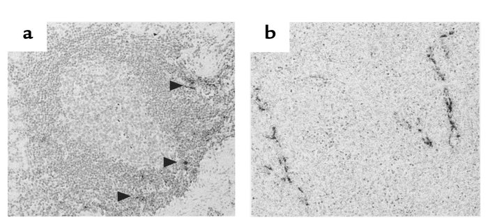 In situ expression of SLC in chronic Hp gastritis (a) and in high-grade ...