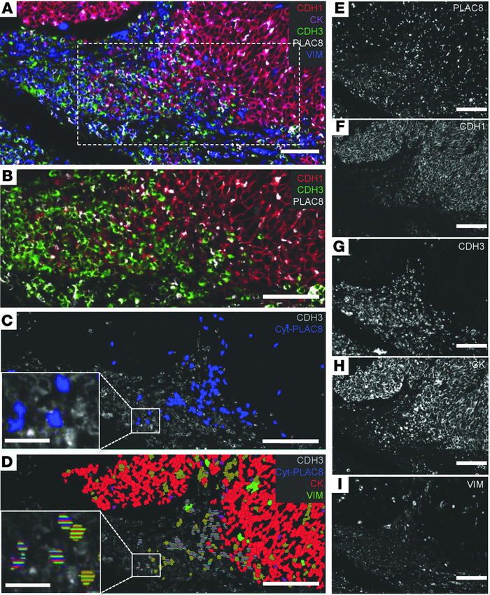 Expression of PLAC8, CDH1, CDH3, CK, and VIM in a medullary CRC.
(A) Com...