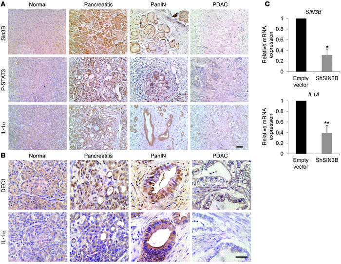 SIN3B levels correlate with an inflammatory response in both human pancr...