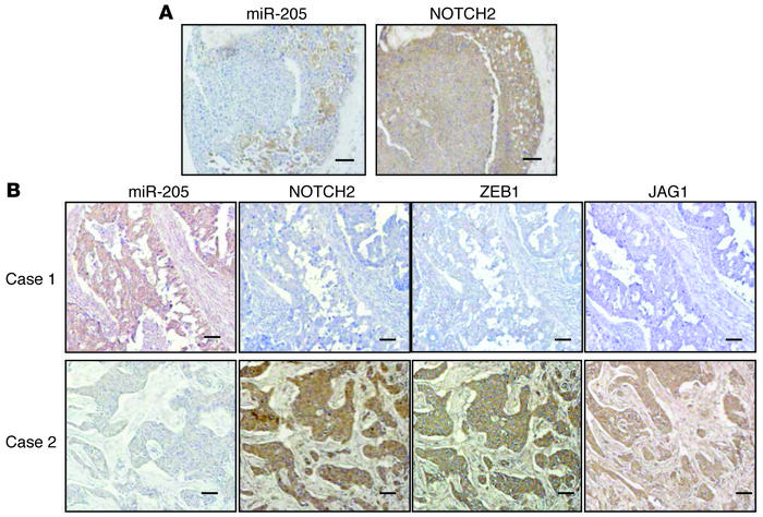 Loss of miR-205 is positively correlated with enhanced expression levels...