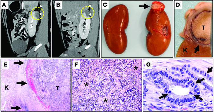 Renal tumor in a TP53R167H/R167H pig.
In case 6, the change in renal tum...