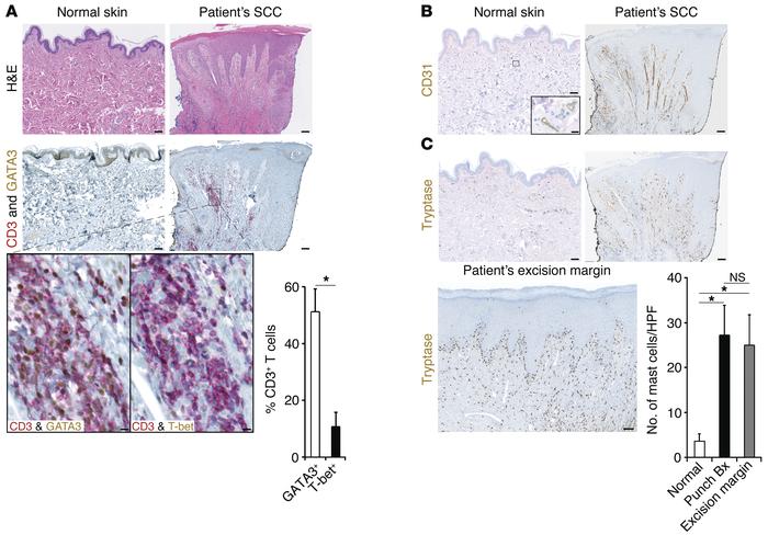 Tumor-promoting inflammation is associated with patient’s SCC.
(A) H&amp...